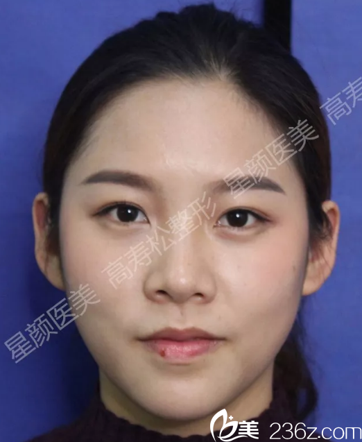 感谢杭州高寿松医生用自体脂肪填充帮我改变了面部轮廓，从此不做透明人