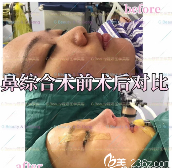 广州姬妍龚湛医生做的鼻子案例对比图