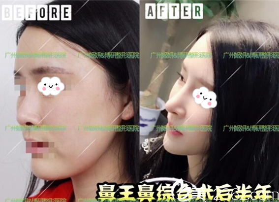 广州鼻王龚湛医生做的鼻综合隆鼻案例半年效果图