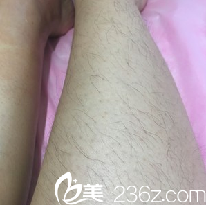 我在延吉李京云整形医院做了腿部激光脱毛毛毛腿瞬间变光滑了