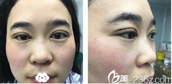 深圳和协门诊部整形美容科双眼皮案例术后即刻效果