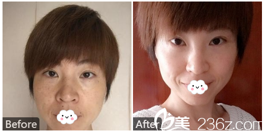广州澳玛星光医疗美容王冠做的激光祛斑案例
