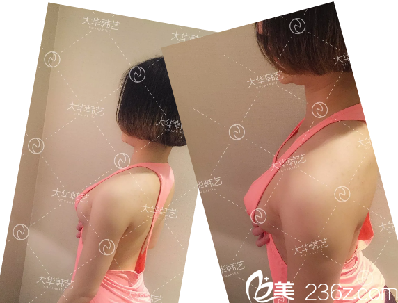 乳房提升术效果图图片