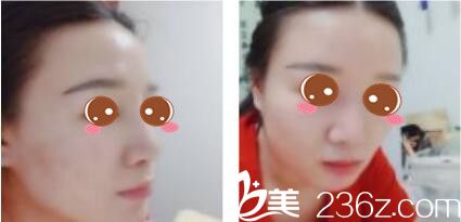 上海信华堂医疗美容门诊部钟国平鼻综合真人案例术后十八天