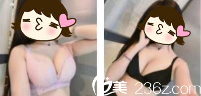 上海信华堂医疗美容门诊部钟国平自体脂肪隆胸真人案例术后第七天