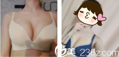 上海信华堂医疗美容门诊部钟国平自体脂肪隆胸真人案例术后两个月