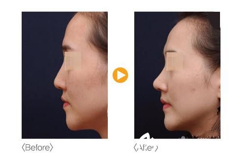 韩国狎鸥亭艾比钮整形外科隆鼻案例
