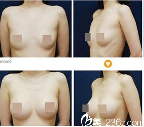 韩国狎鸥亭艾比钮整形外科假体隆胸案例