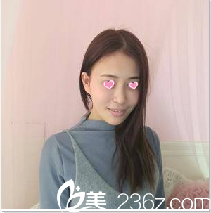 公开我在北京八大处找陈光宇注射瘦脸第28天真实效果和价格