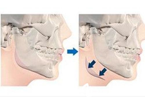 下颌角手术