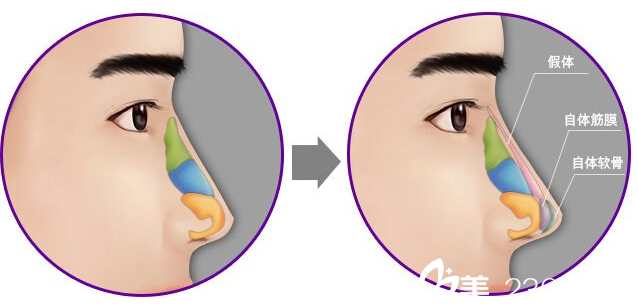 假体隆鼻二次修复需要注意哪些问题
