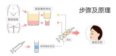 广州华美自体脂肪填充步骤图