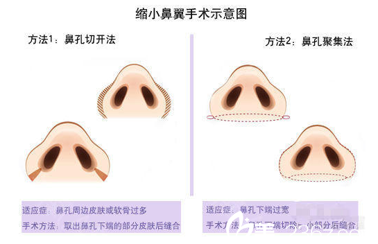 鼻翼缩小手术方法