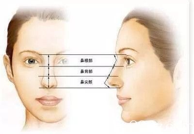 取出隆鼻假体后，鼻子还能恢复原样吗？