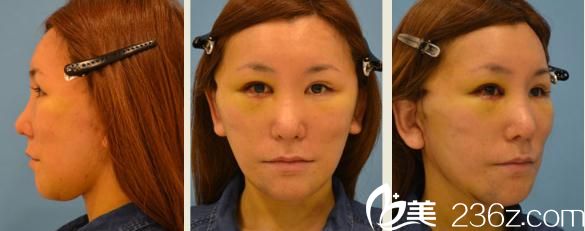 铃木芳郎面部大拉皮手术第四天的照片