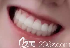 10岁女儿在深圳格伦菲尔口腔做金属托槽牙齿矫正9个月的效果，证明价格不贵