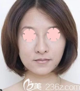 30岁宝妈在柳州仁美整形做全脸线雕提升前后对比照片及恢复过程分享