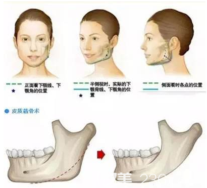 韩国DA整形医院面部轮廓整形优惠价格全新公布！磨骨瘦脸下颌角手术5.5W起