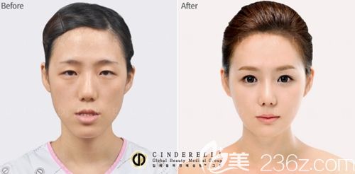 韩国灰姑娘(新帝瑞娜)面部轮廓+电眼整形案例
