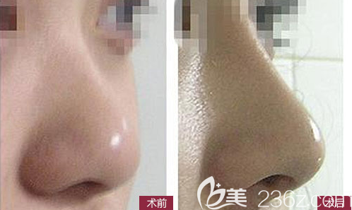 四川省人民医院整形美容科刘全隆鼻后对比图