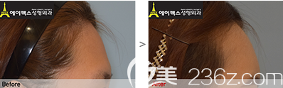 韩国爱佩思APEX整形宋铉锡额头填充案例对比图