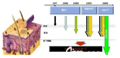 激光去红血丝