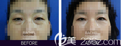 韩国蕾切尔眼底脂肪重置手术案例对比效果图