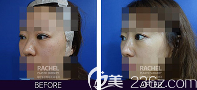 韩国蕾切尔医院柳承来双眼皮过宽无神修复案例效果对比图