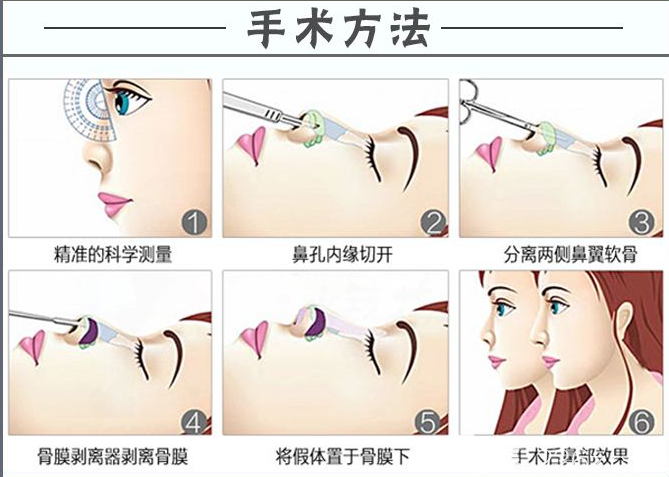 韩式隆鼻过程与手术方法图解