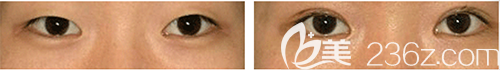 韩国lucea整形外科双眼皮手术案例