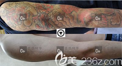 韩国Clean Tattoo手臂去纹身案例