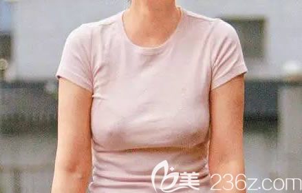 杭州时光整形美容医院王立刚讲解如何矫正乳房下垂附案例及价格