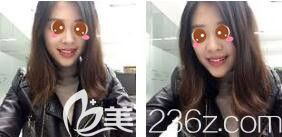 上海光博士医疗美容门诊部吴莉平玻尿酸隆鼻真人案例术后二十三天