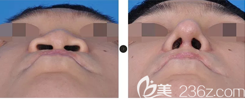 韩国韩娜鼻整形医院张槿旭院长假体隆鼻失败修复案例效果对比图
