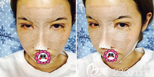 在韩国POP整形医院做鼻综合＋全切双眼皮修复手术当天