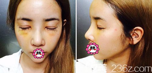 在韩国POP整形医院做鼻综合＋全切双眼皮修复术后5天