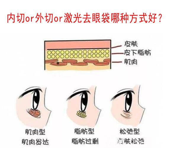 韩国纯真整形医院讲去眼袋,为什么建议做眼底脂肪重新排列不建议割