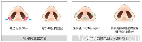 鼻翼缩小手术过程图