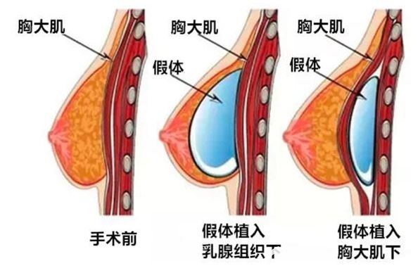 隆胸假体放入过程图片