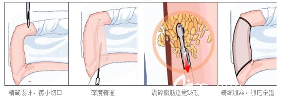 手臂抽脂手术过程