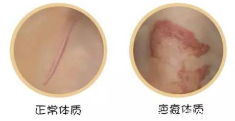 小磕小碰很容易留疤是不是可以判断为疤痕体质