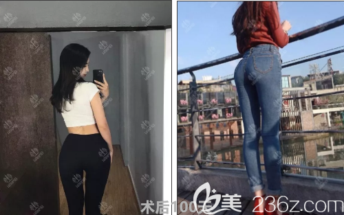 遵义韩美整形公开一位屁股扁平妹子做自体脂肪丰臀三个月后效果图。