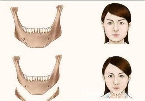 下颌角整形让你大饼脸变小V脸