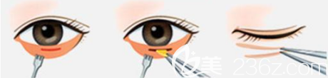 祛眼袋手术过程图
