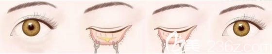 内切祛眼袋手术过程图