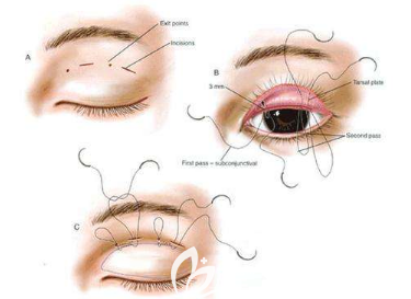 全切双眼皮示意图