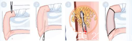 手臂抽脂手术过程图