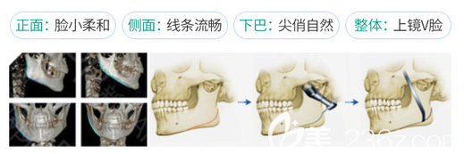 广州广大整形医院柳超做下颌角整形优势