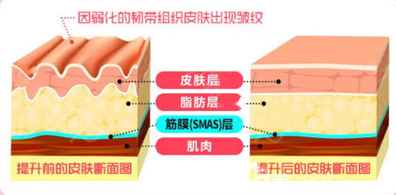 面部筋膜提升前后皮肤断面图