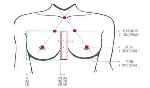做过假体隆胸手术的来说说是不是术后乳房中间都很宽挤不出乳沟?